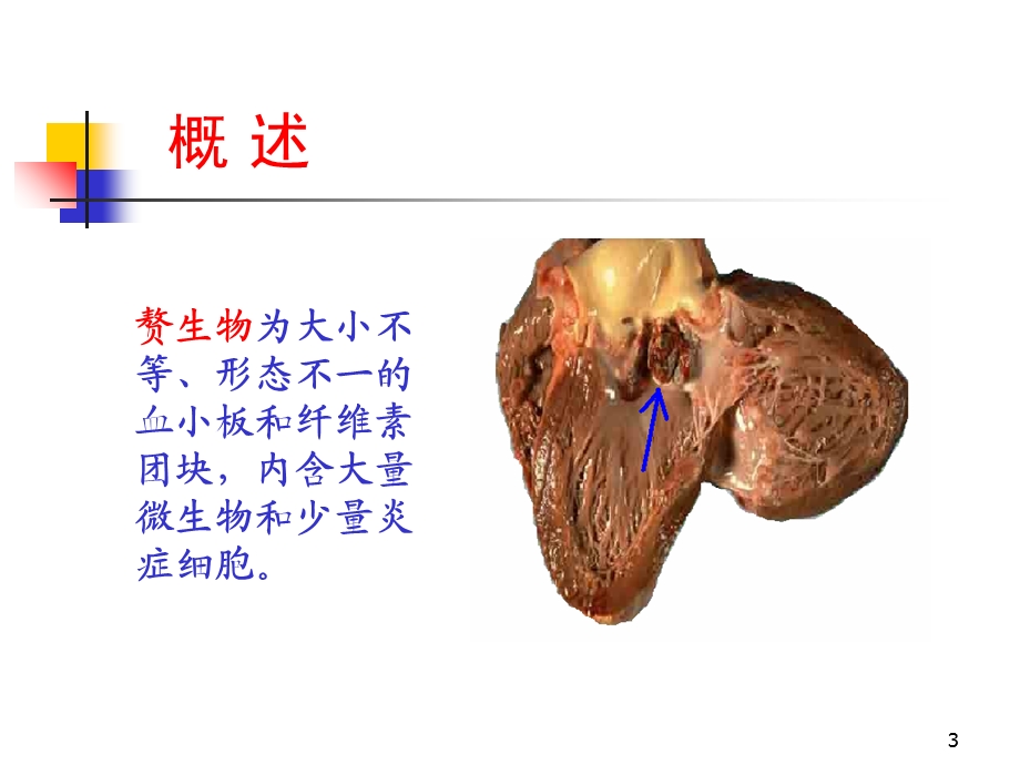 感染性心内膜炎2学时.ppt_第3页