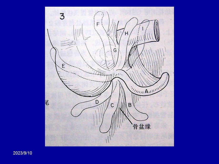 急性阑尾炎手术治疗.ppt_第3页