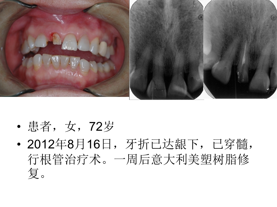 牙齿残根不要拔保存治疗有办法.ppt_第2页