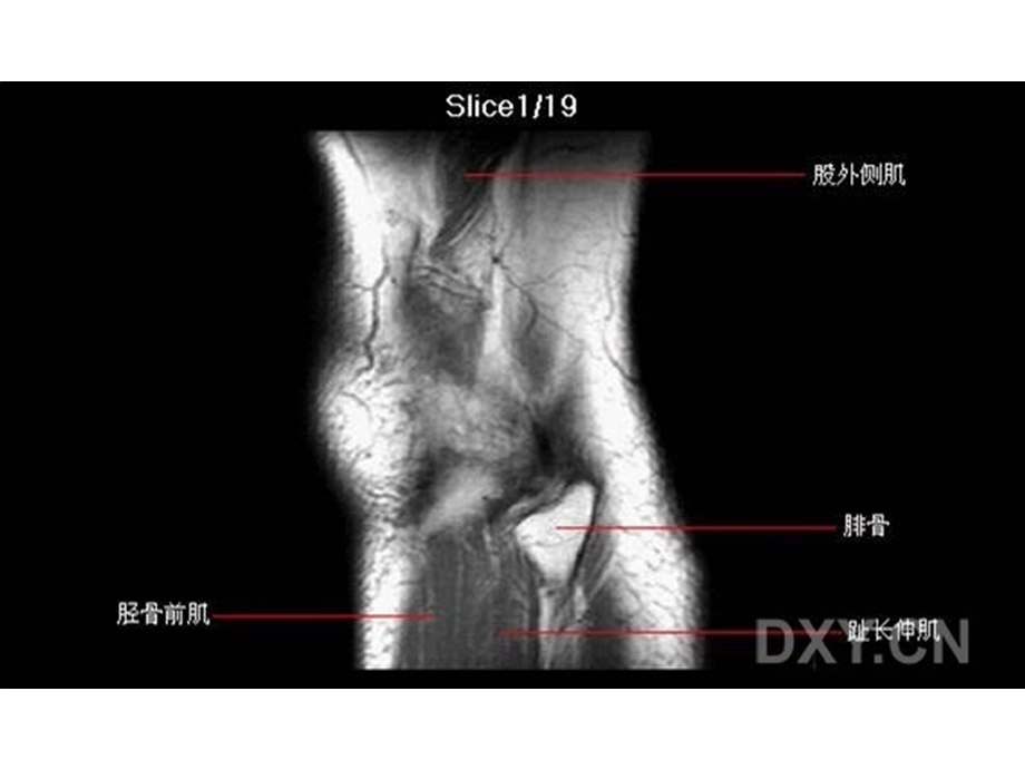 膝关节正常MRI解剖图谱resonance关节.ppt_第1页