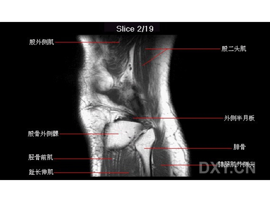 膝关节正常MRI解剖图谱resonance关节.ppt_第2页