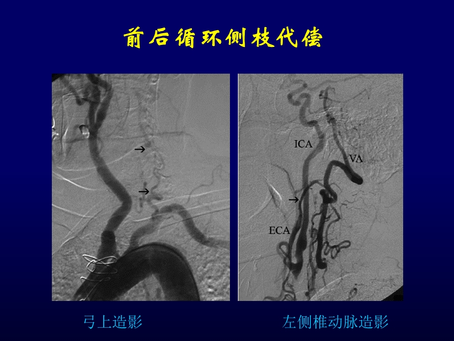 缺血性脑血管病造影的技术要点.ppt_第3页