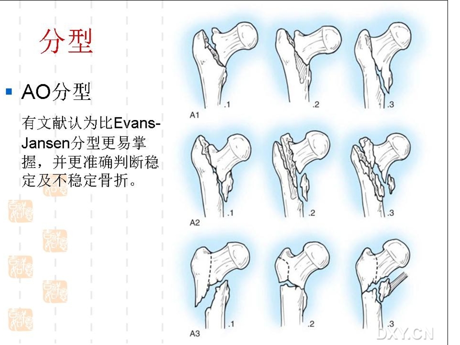 股骨粗隆间骨折的内固定治疗的选择及策略.ppt_第2页