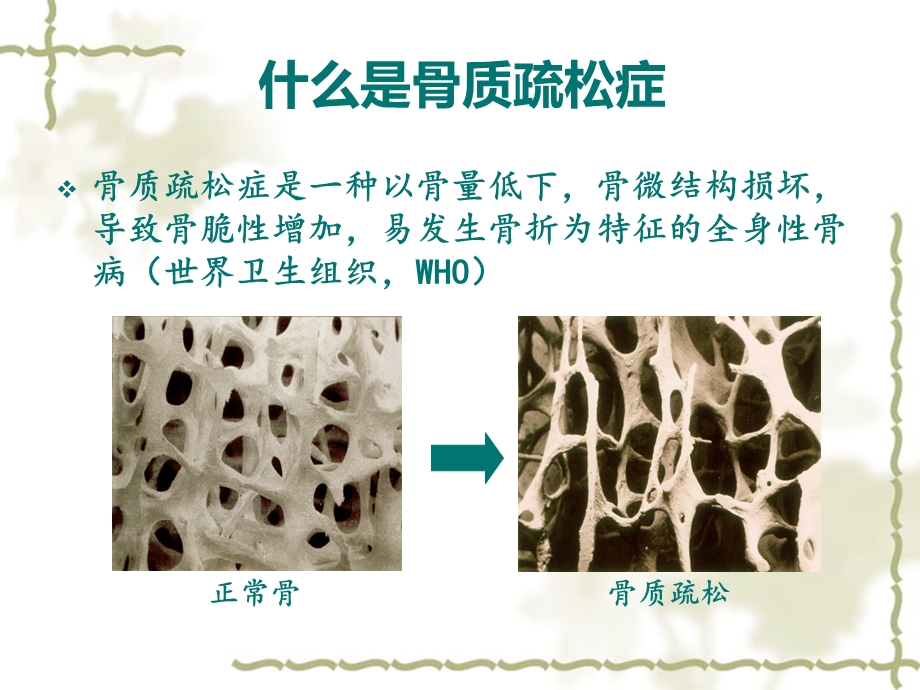 骨质疏松症(fiinal).ppt_第2页