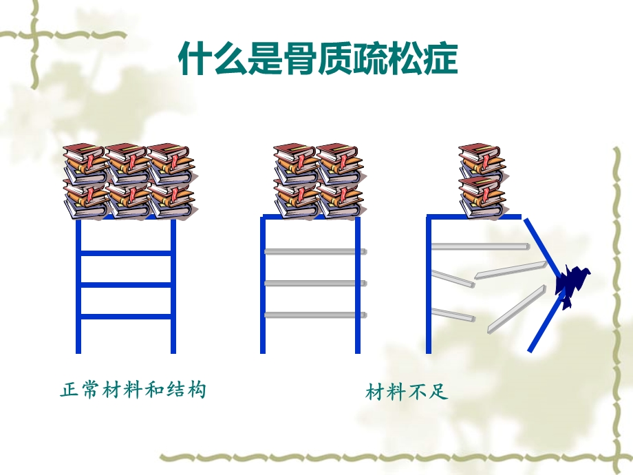 骨质疏松症(fiinal).ppt_第3页