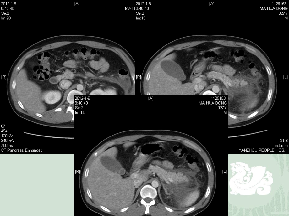 胰腺常见变异CT及MRI表现.ppt_第3页