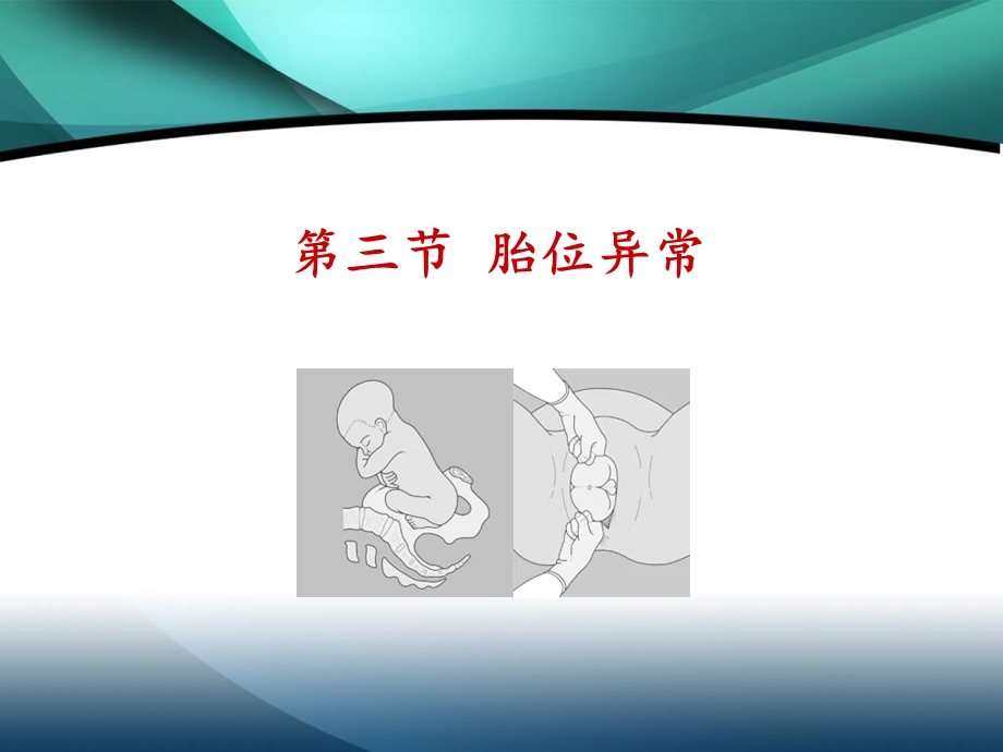 八年制胎位异常.ppt_第2页