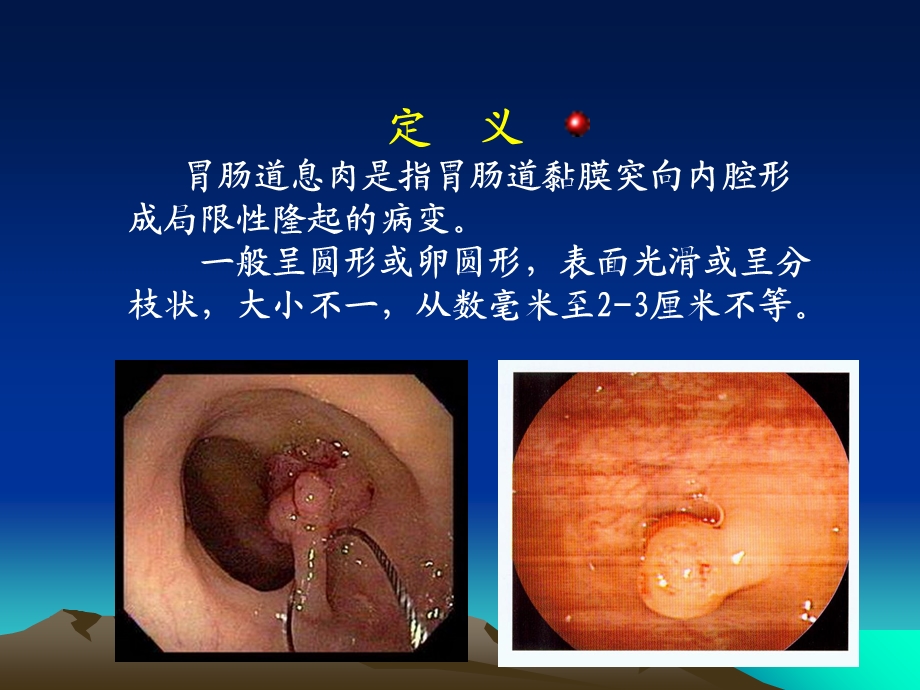 胃肠道息肉内镜下电凝切除术.ppt_第2页