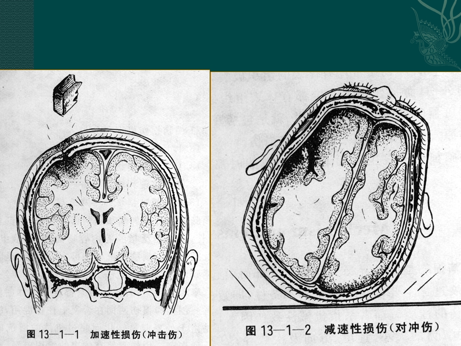 颅脑外伤的CTMR诊断.ppt_第3页