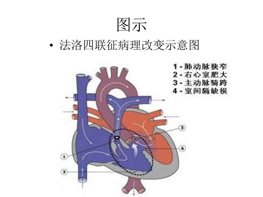 肺动脉瓣狭窄的超声.ppt_第3页