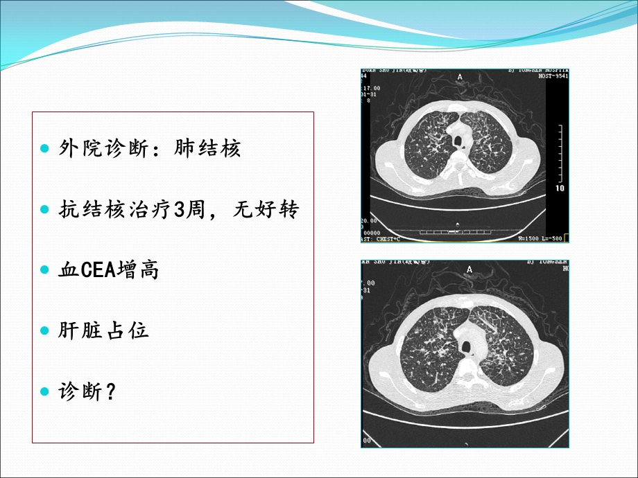 肺癌的预防和早期发现.ppt_第3页