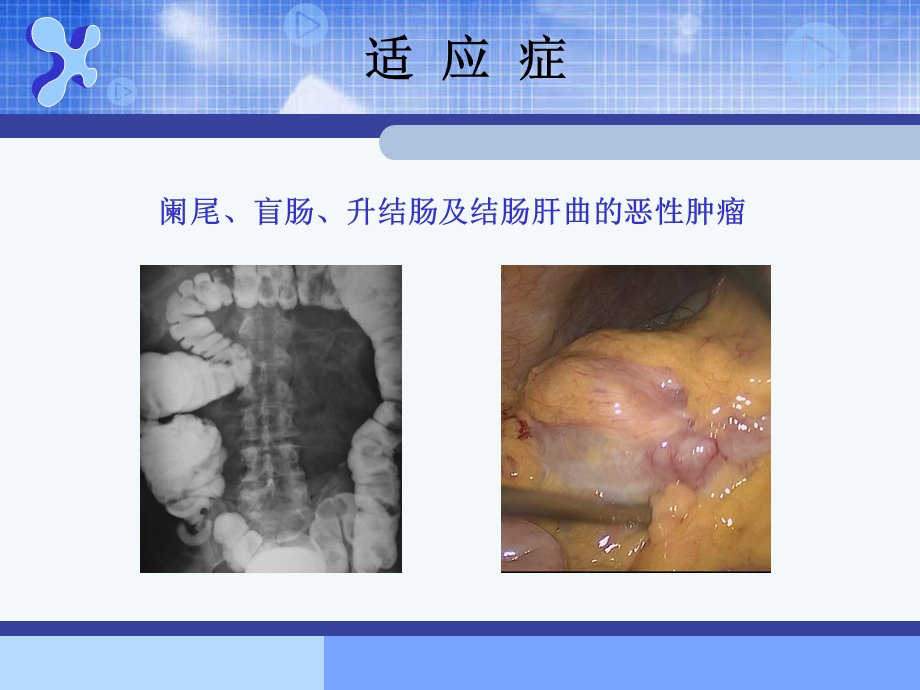 腹腔镜右半结肠切除术.ppt_第3页