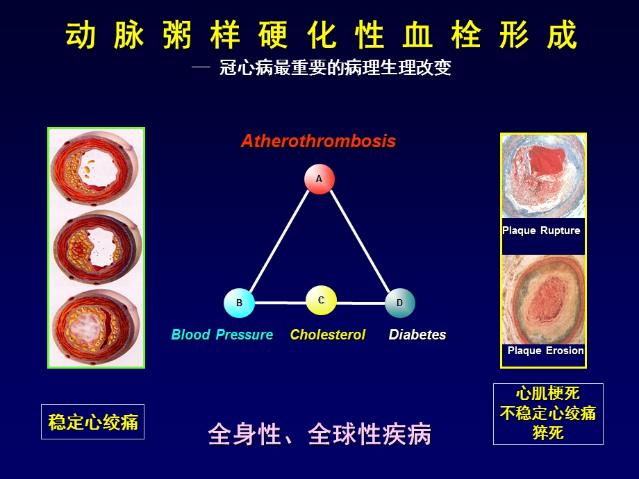 冠心病抗血小板治疗.ppt_第2页