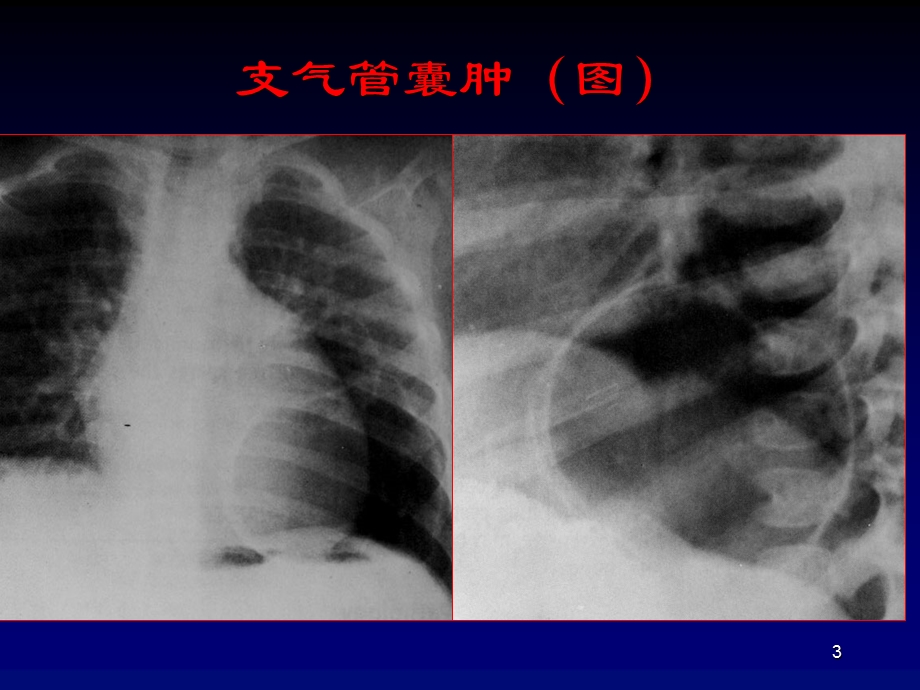 《呼吸各论-见习》ppt课件.ppt_第3页