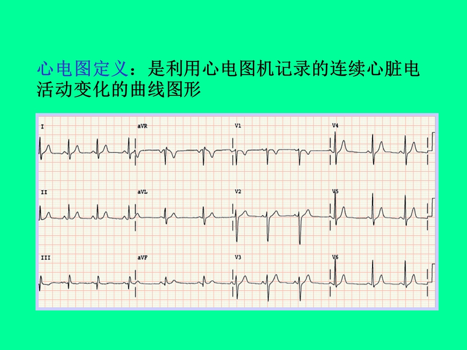 诊断学(实验)心电图教学.ppt_第3页