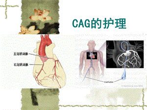 《cag的护理》ppt课件.ppt