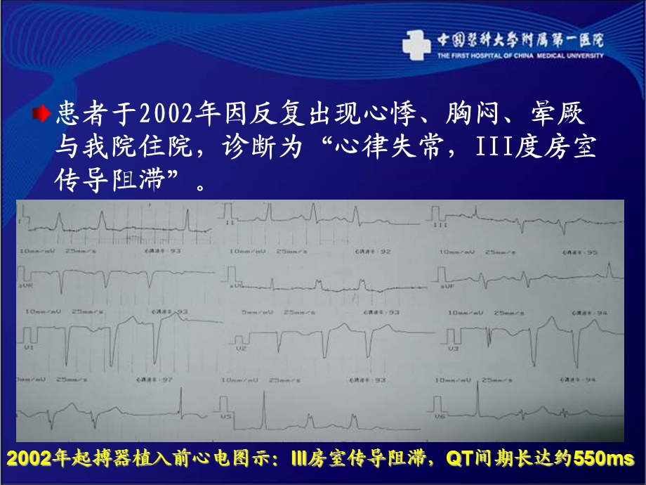 iii度房室传导阻滞及获得性长qt心衰患者起搏器升级治疗选择与疑惑程颖文档资料.ppt_第2页