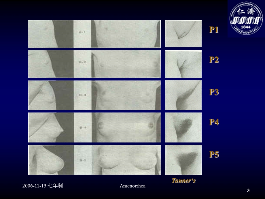 最新Amenorhea妇产科仁济临床医院PPT文档.ppt_第3页
