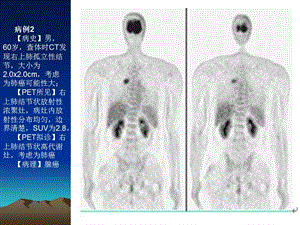 最新PET病例PPT文档.ppt