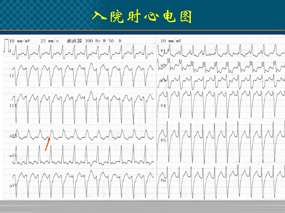 心律失常病例精选文档.pptx_第2页