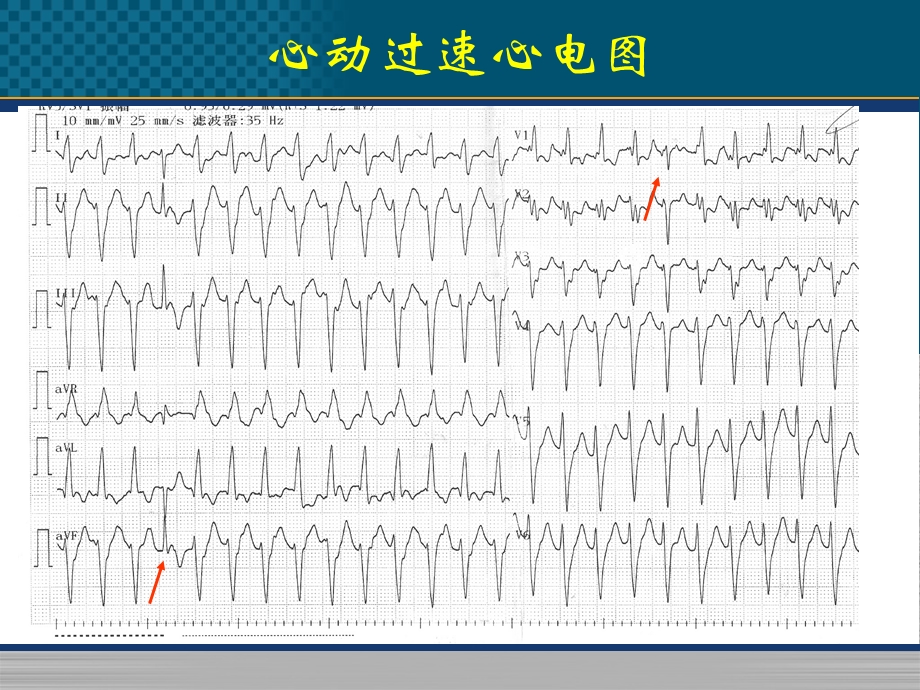 心律失常病例精选文档.pptx_第3页
