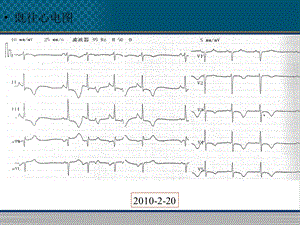 心律失常病例精选文档.pptx