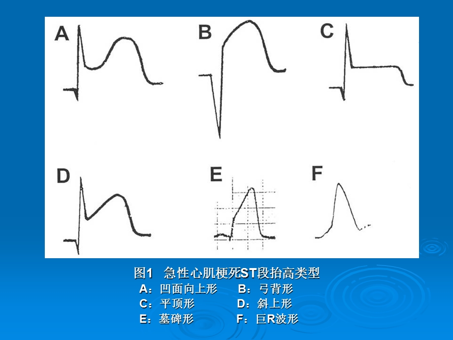 “巨R波形”ST段抬高的特性及其临床意义文档资料.ppt_第3页