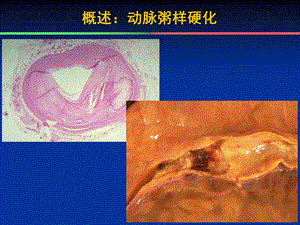 24章 抗动脉粥样硬化药课件PPT文档精选文档.ppt