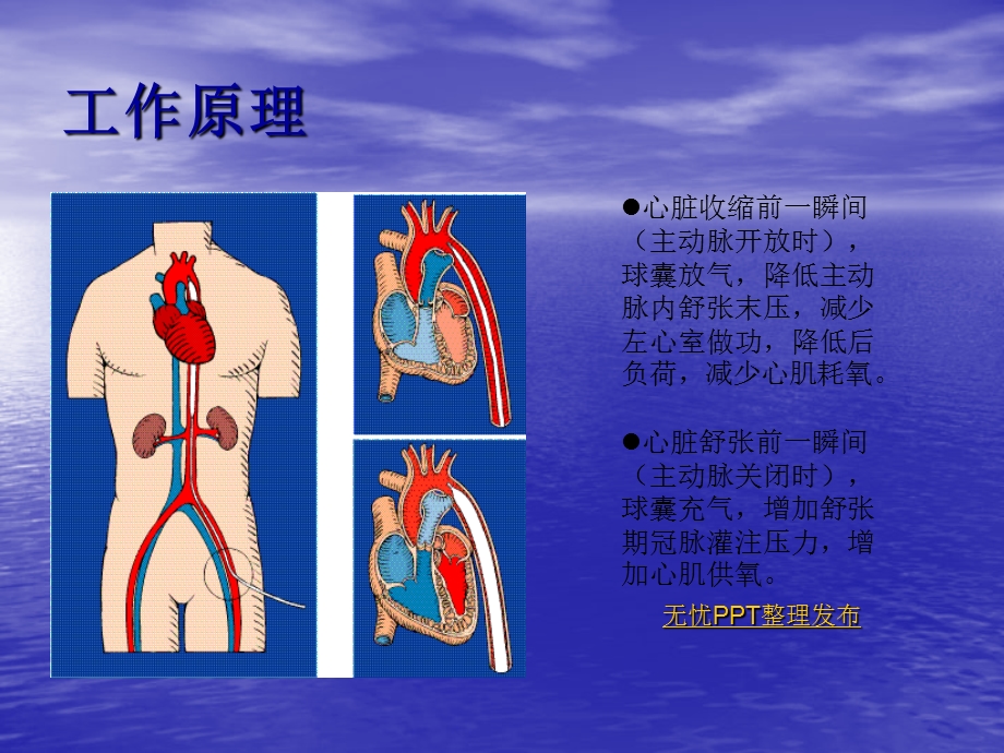 主动脉球囊反搏护理ppt课件文档资料.ppt_第3页