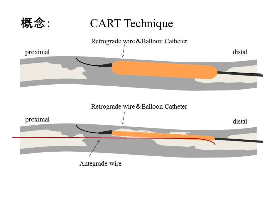 cto病变：反向cart技术临床应用金恩泽PPT文档.ppt_第2页