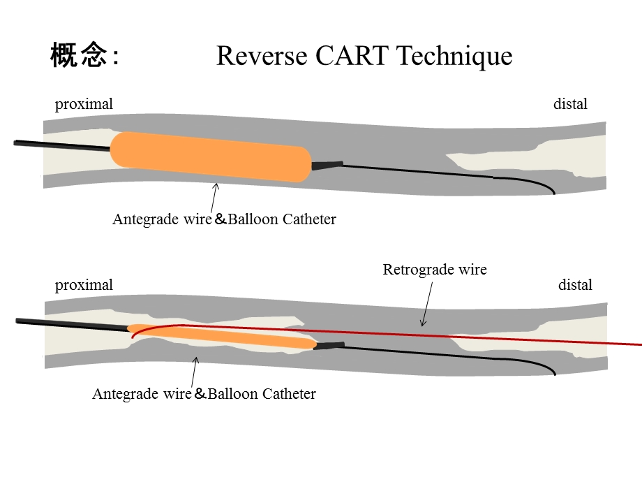 cto病变：反向cart技术临床应用金恩泽PPT文档.ppt_第3页