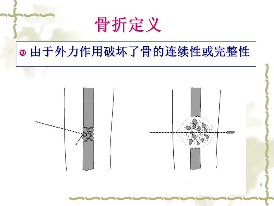 骨折概论ppt课件文档资料.ppt_第1页