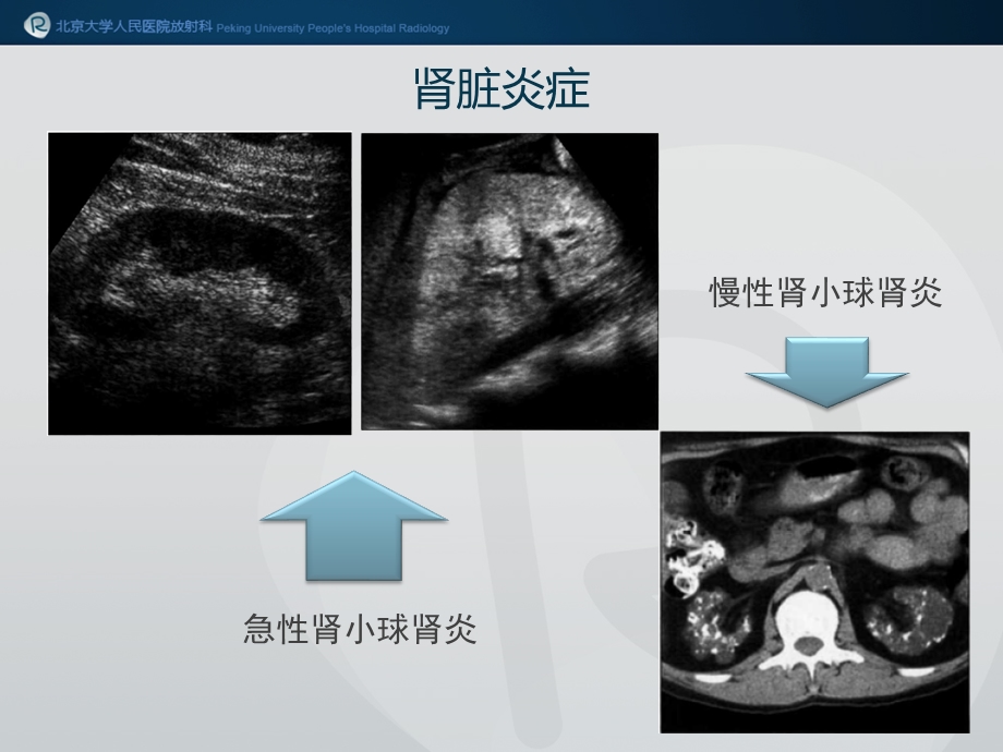 双肾弥漫病变文档资料.pptx_第3页