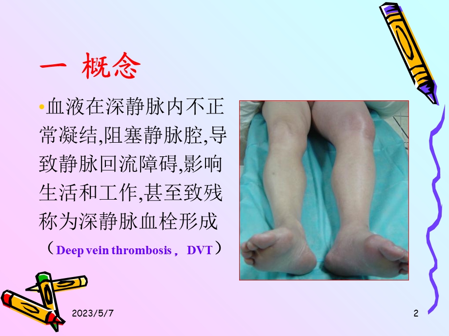 下肢dvt的护理文档资料.ppt_第2页