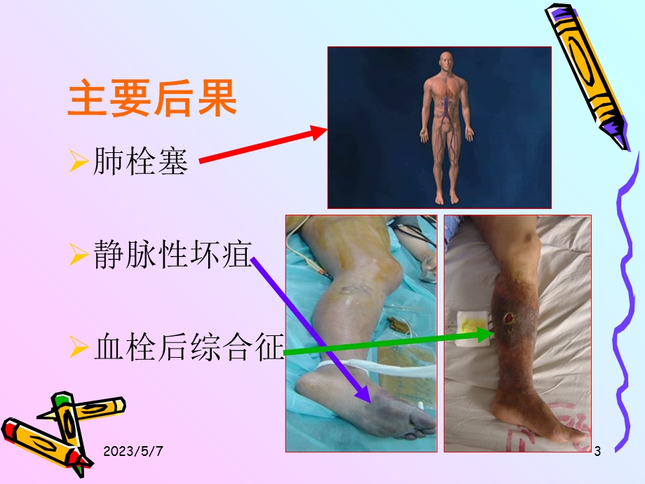 下肢dvt的护理文档资料.ppt_第3页