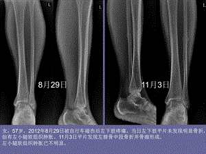 不寻常骨折的影像学分析ppt课件文档资料.ppt