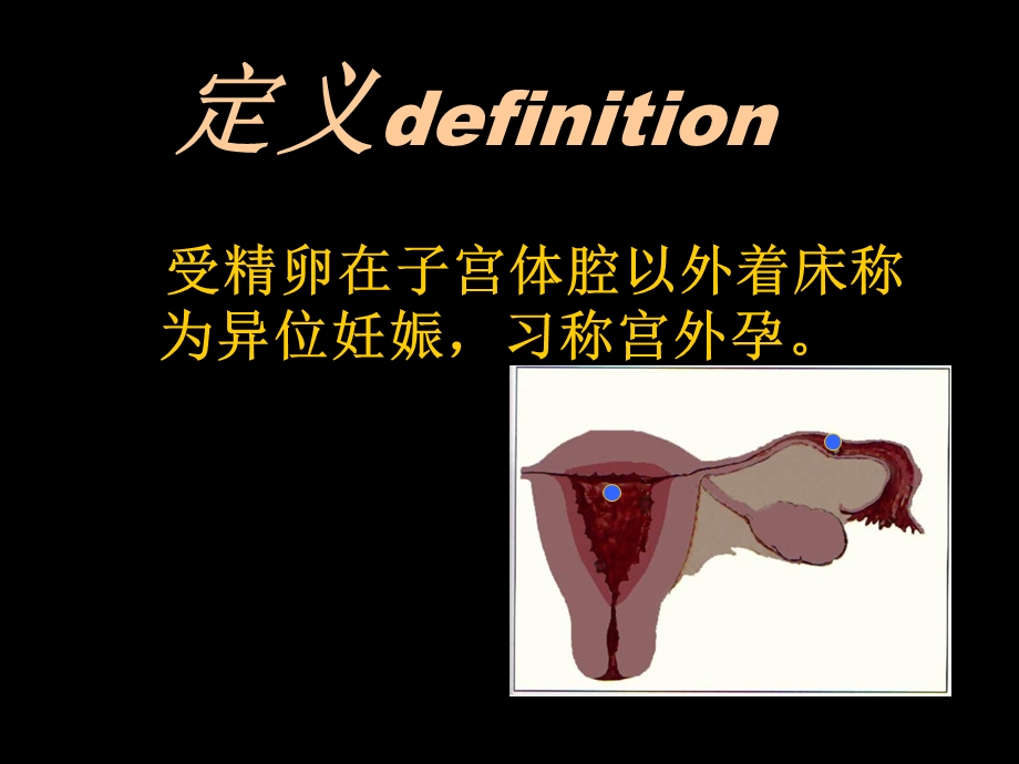 异位妊娠PPT课件文档资料.ppt_第1页