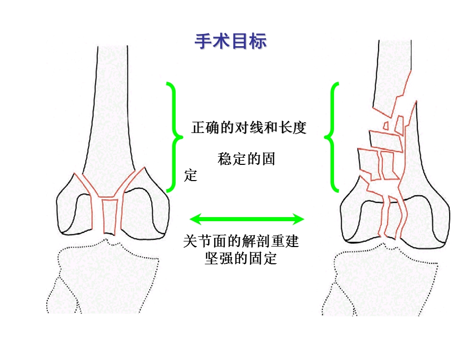 ao膝关节骨折文档资料.ppt_第3页