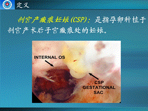 剖宫产瘢痕部位妊娠课件文档资料.ppt