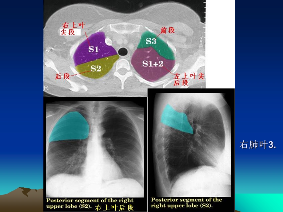 CT正常彩色解剖图肺段PPT文档.ppt_第3页