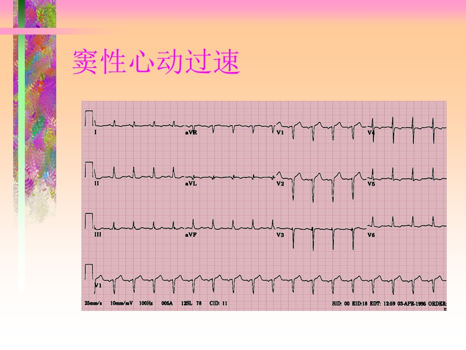 【医药健康】围术期心律失常文档资料.ppt_第3页