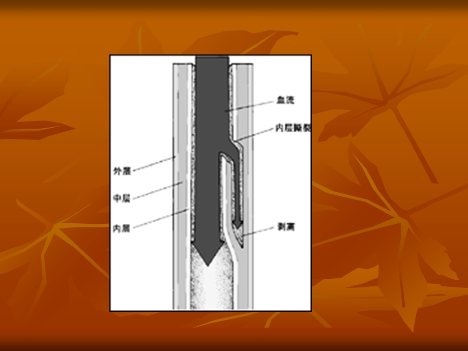 主动脉夹层文档资料.ppt_第2页