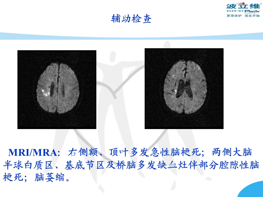 卒中病例ppt课件文档资料.ppt_第3页