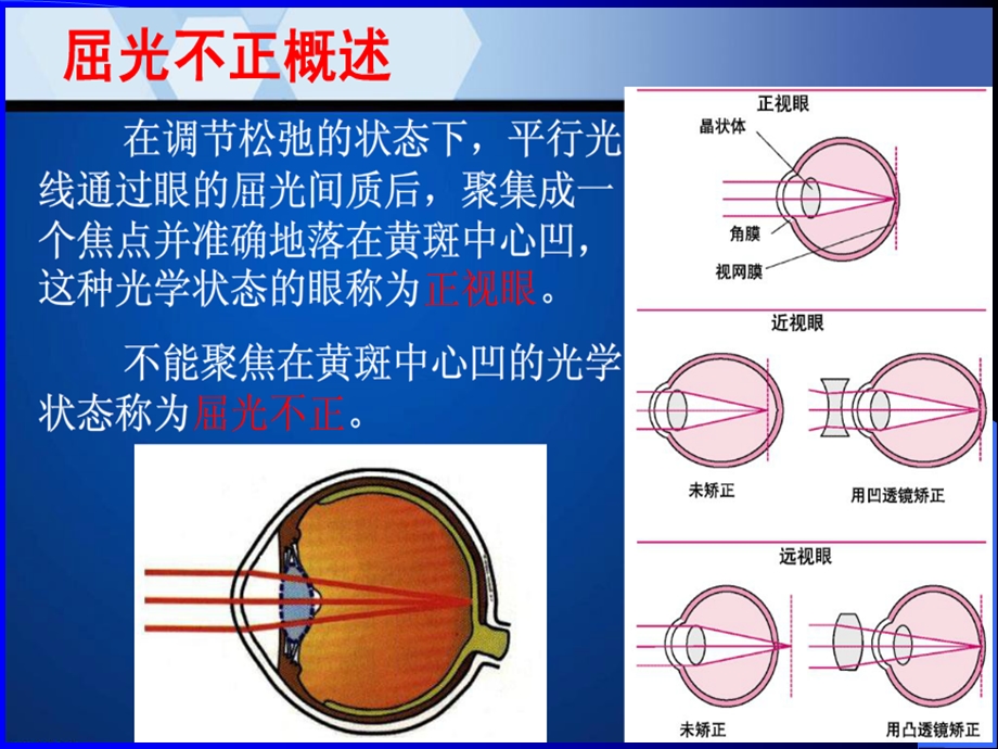 p55.屈光不正、斜视和弱视病人的护理文档资料.ppt_第3页