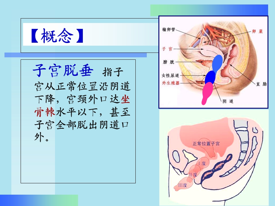 《子宫脱垂》课件.ppt_第2页