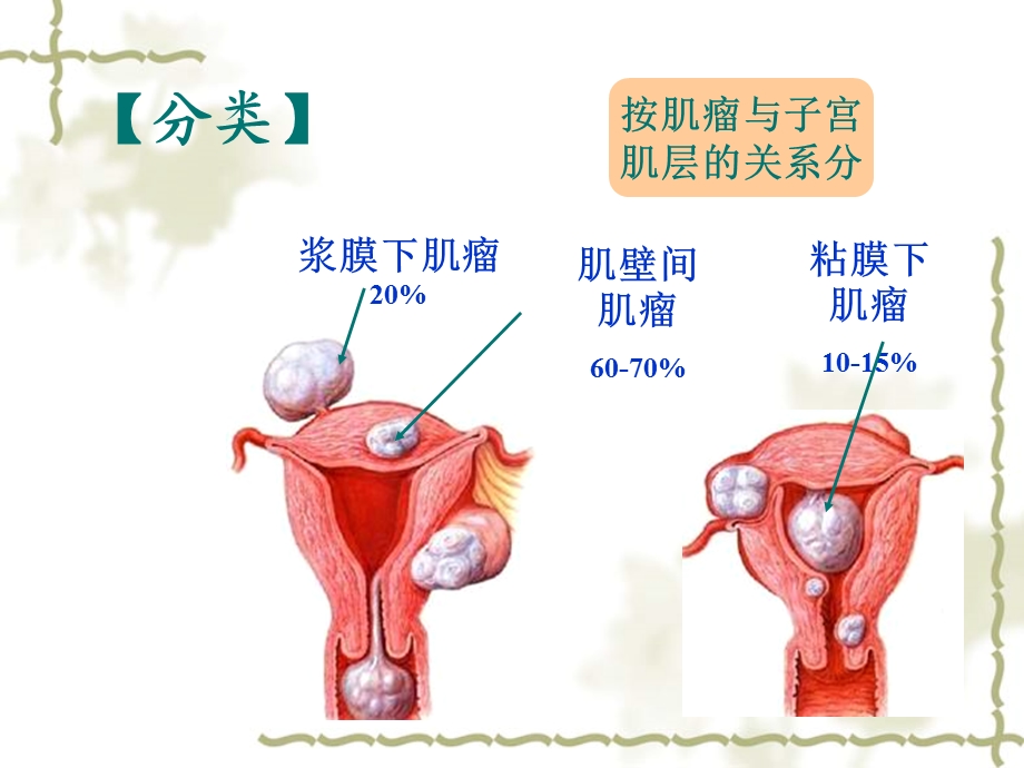 《子宫肌瘤护理》ppt课件.ppt_第3页