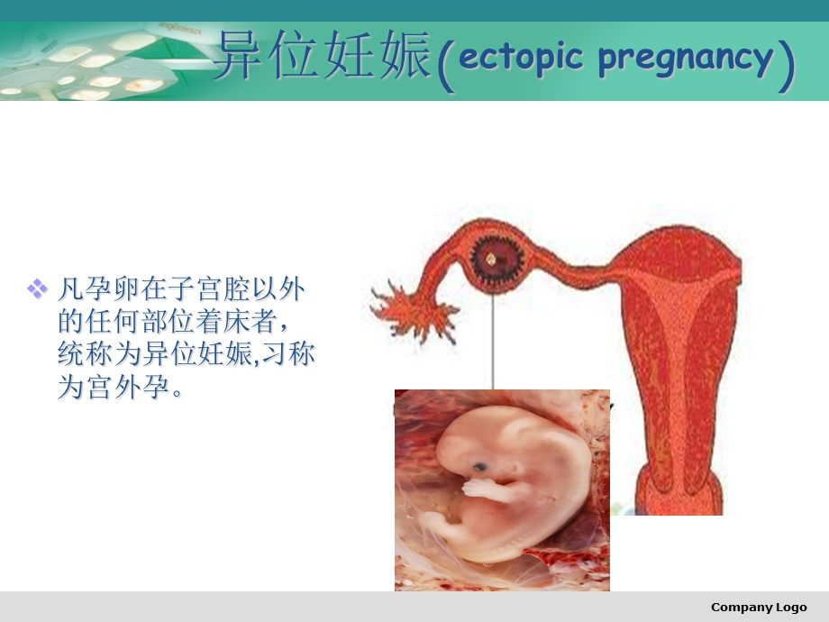 《异位妊娠公莉》课件.ppt_第2页