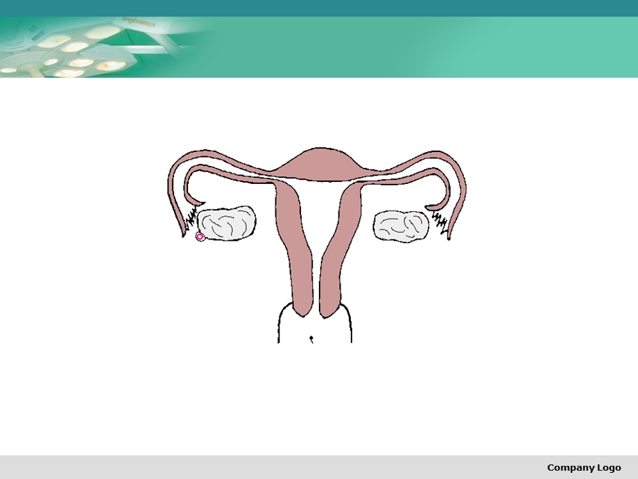 《异位妊娠公莉》课件.ppt_第3页