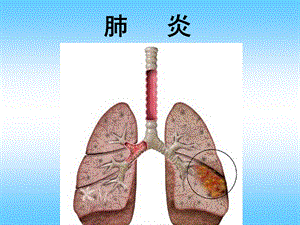 《肺炎护理》课件.ppt