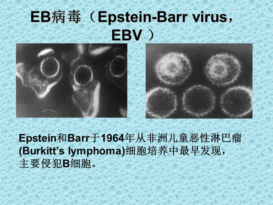 传染性单核细胞增多症-夏雅.ppt_第3页